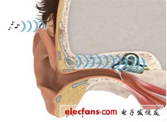 通过将骨传导助听器植入中耳的位置，听力障碍的病人可以恢复正常的听力。