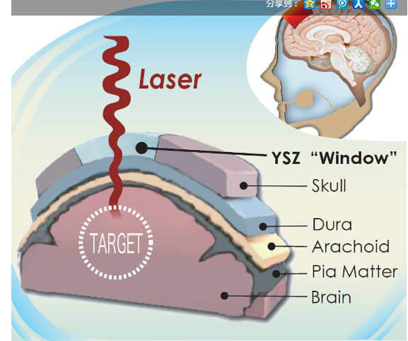 为头骨打造出“可视窗户”技术出炉，对大脑的监测更加高效