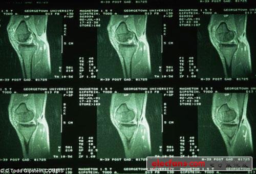 MRI扫描出的膝关节图像
