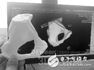 医生快速完成复杂髋部骨折手术原来全靠3D打印模型