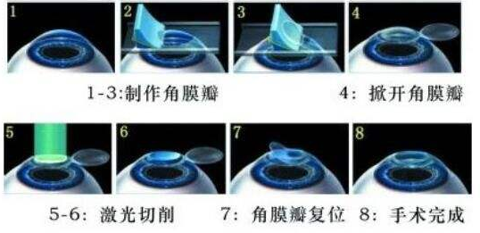 近视激光手术：准分子、飞秒、全飞秒的区别解析